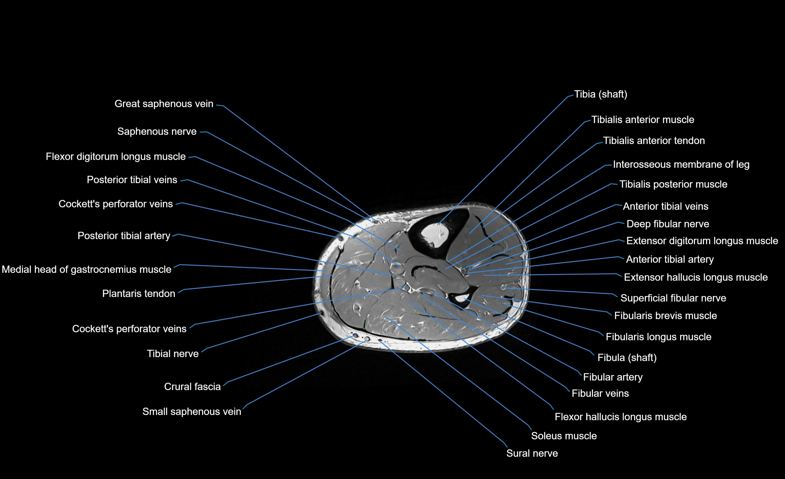 MRI lower leg axial cross sectional anatomy 3T  radiology  image-img-00001-00055.webp